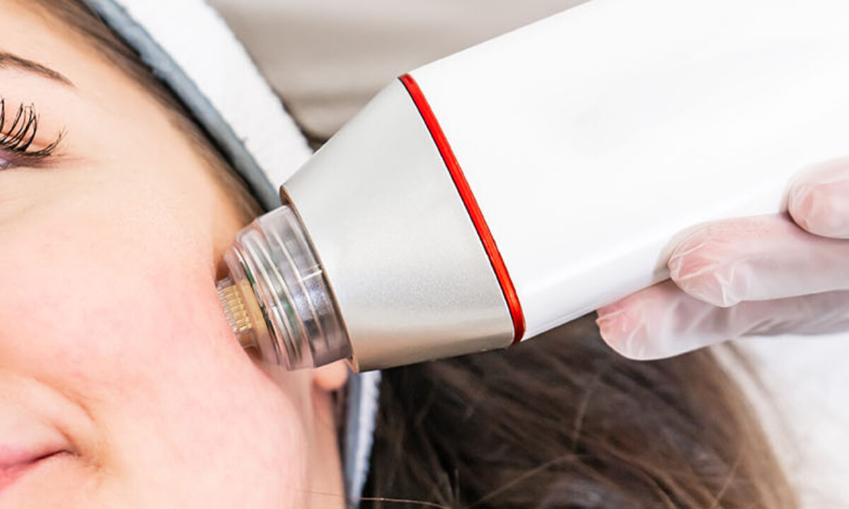 files/rf-microneedling-1200x720.jpg