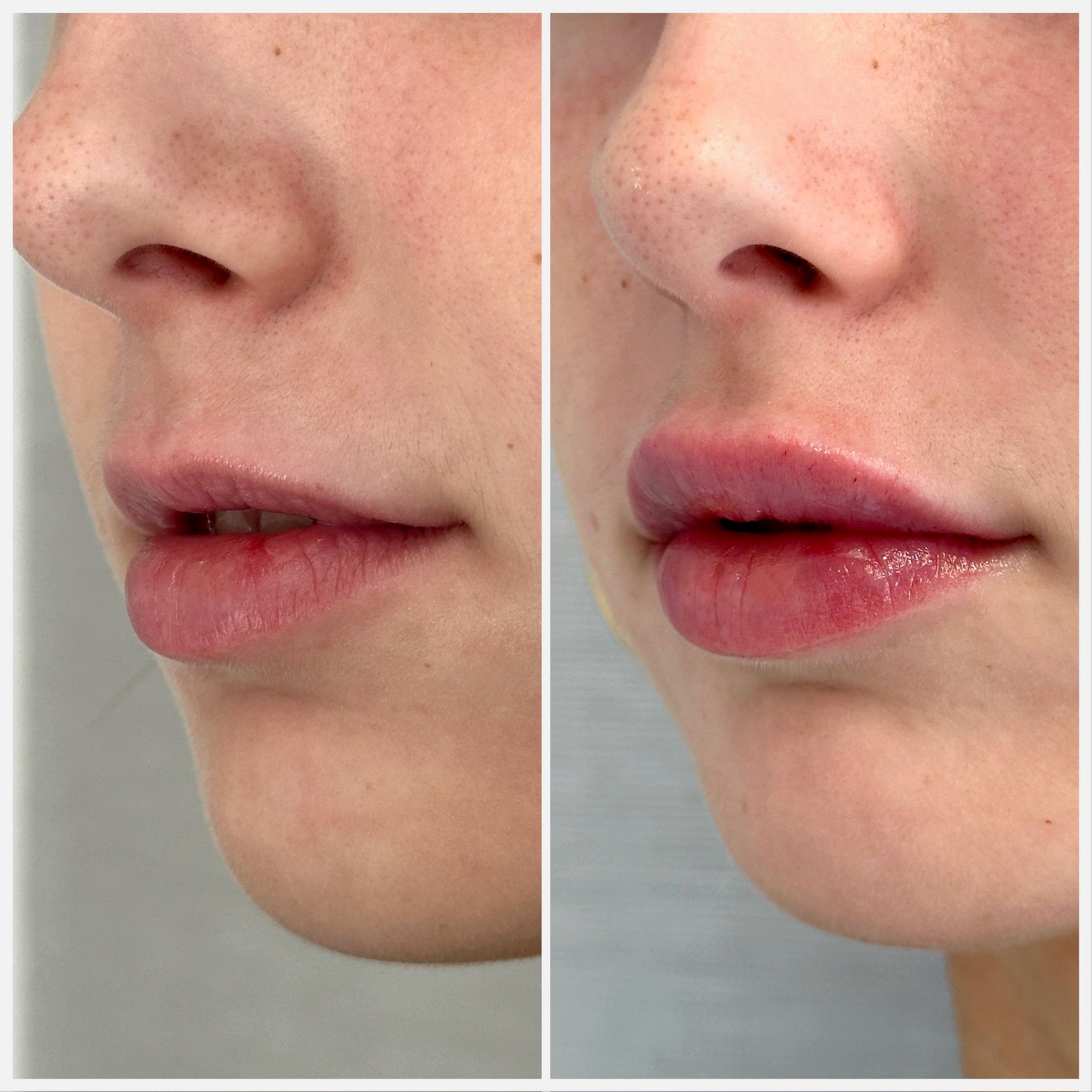files/lip_filler.jpg