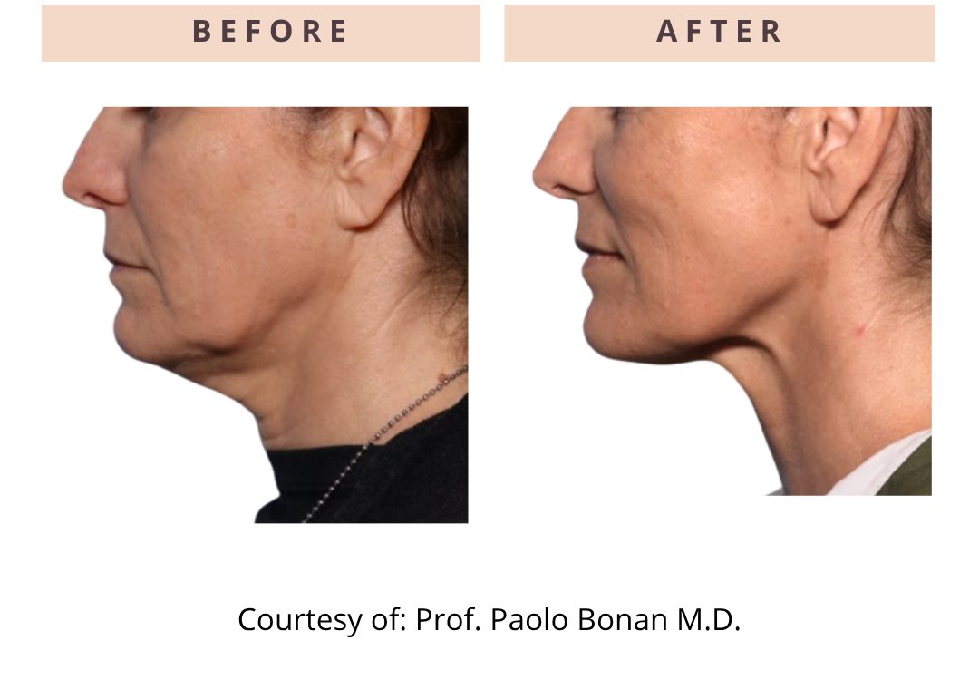 files/onda-pro-before-after-double-chin.jpg