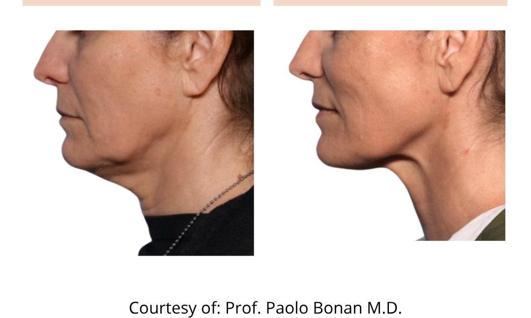 Onda Pro Coolwaves double chin before and after at Skin Select